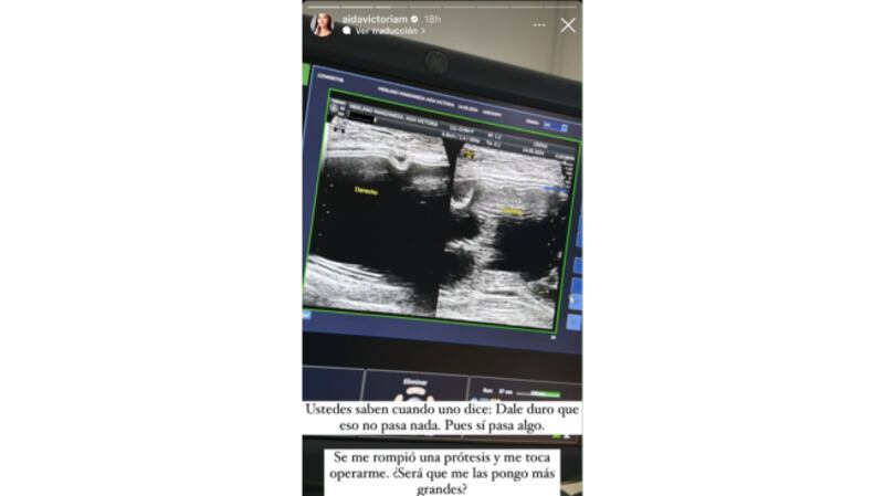 Aida Victoria cuenta que se le explotó una protesis de sus senos (Captura tomada de las redes sociales de Aida Victoria)